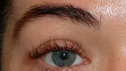 Eyebrow Transplant patient result at DRKAYA Clinic