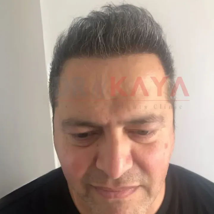 DHI patient result at DRKAYA Clinic
