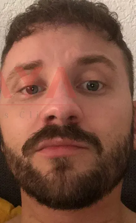 Beard Transplant patient result at DRKAYA Clinic