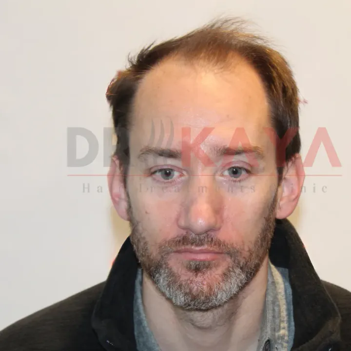Hybrid Method patient before hair transplant at DRKAYA Clinic