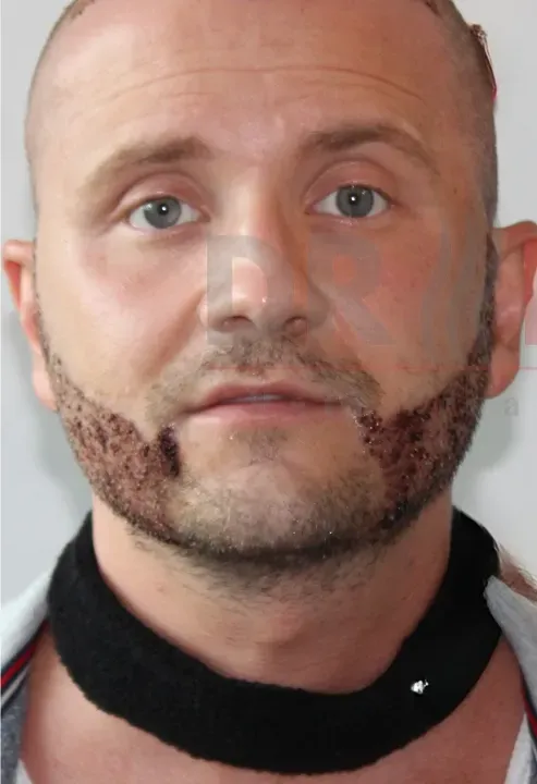 Beard Transplant patient before hair transplant at DRKAYA Clinic