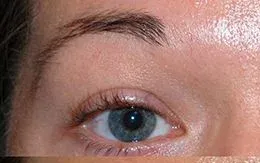 Eyebrow Transplant patient before hair transplant at DRKAYA Clinic