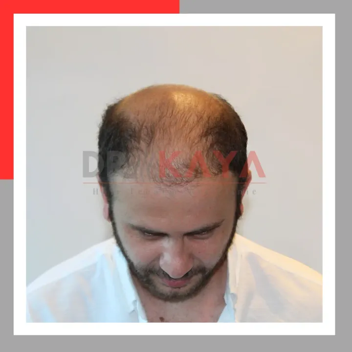Sapphire FUE patient before hair transplant at DRKAYA Clinic