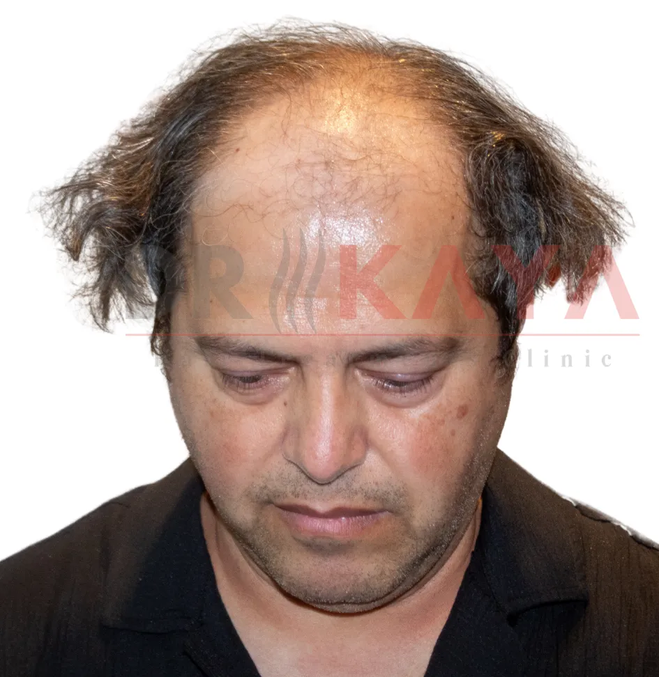 DHI patient before hair transplant at DRKAYA Clinic